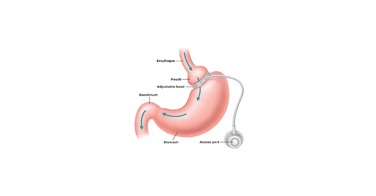 Inel Gastric