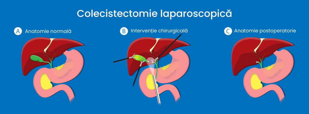 Colecistectomie – operație de pietre la fiere – intervenție laparoscopică